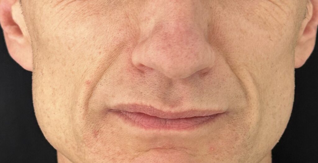 Nasolabial folds before treatment with Dermal filler on a Man