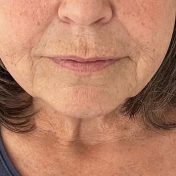 Marionettes before treatment with Dermal filler