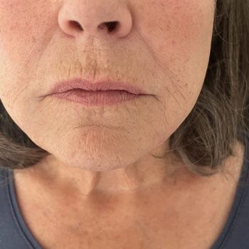 Marionettes after treatment with Dermal filler